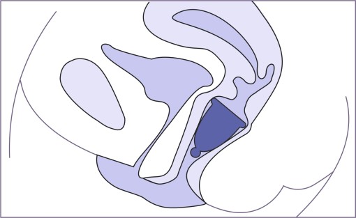 la position exacte d'une coupe menstruelle -  Nappilla 